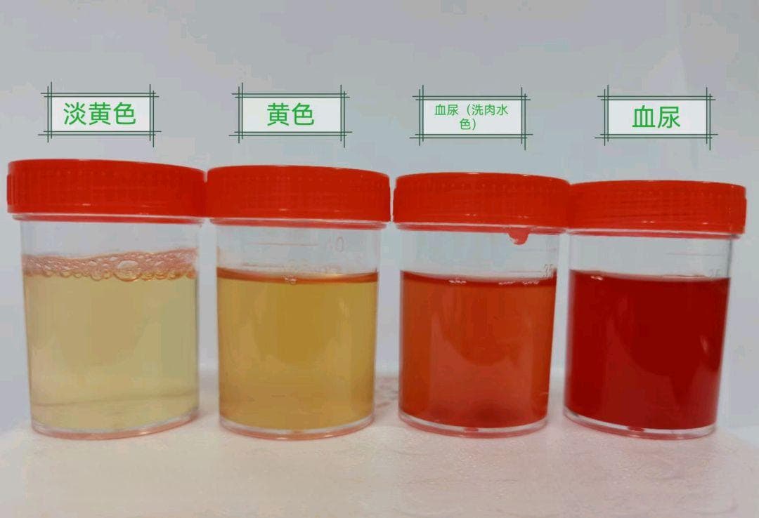 血尿，不可忽视的健康预警