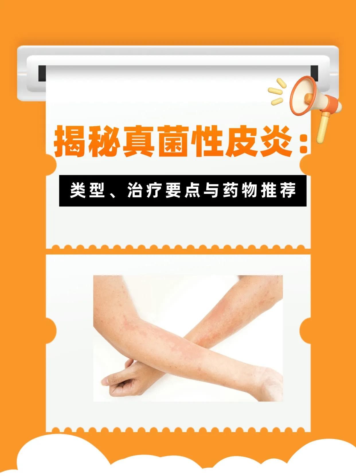 真菌性皮炎：类型、治疗要点与药物推荐全攻略