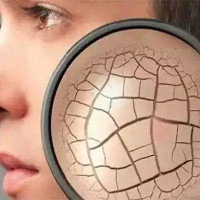 皮肤的“旱灾”：乏脂性湿疹的肆虐与应对