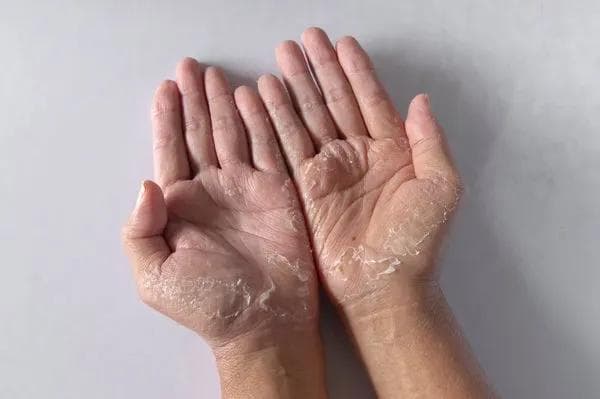 手掌心有水泡什么原因