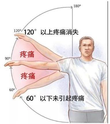 【痛弧征】肩峰下撞击综合征的诊与疗