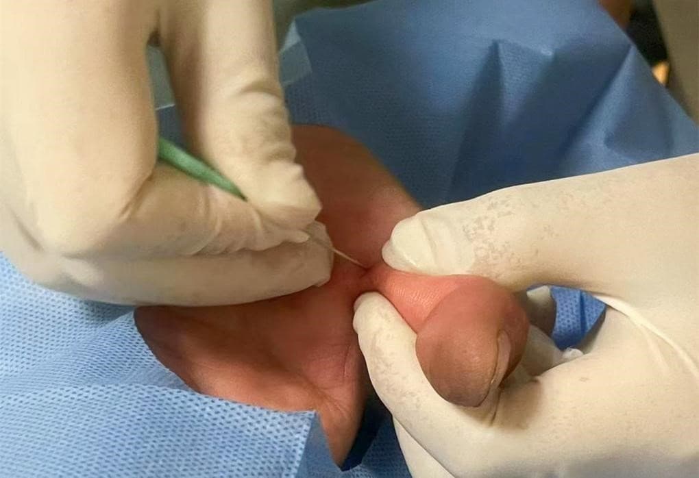 小针刀松解治疗（扳机指）屈指肌狭窄性腱鞘炎