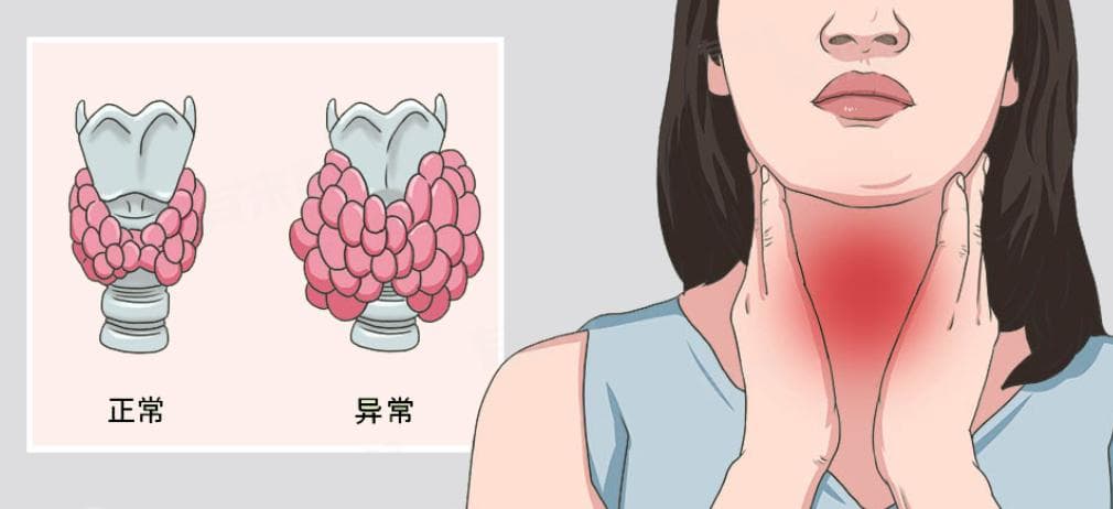 为什么会得桥本甲状腺炎