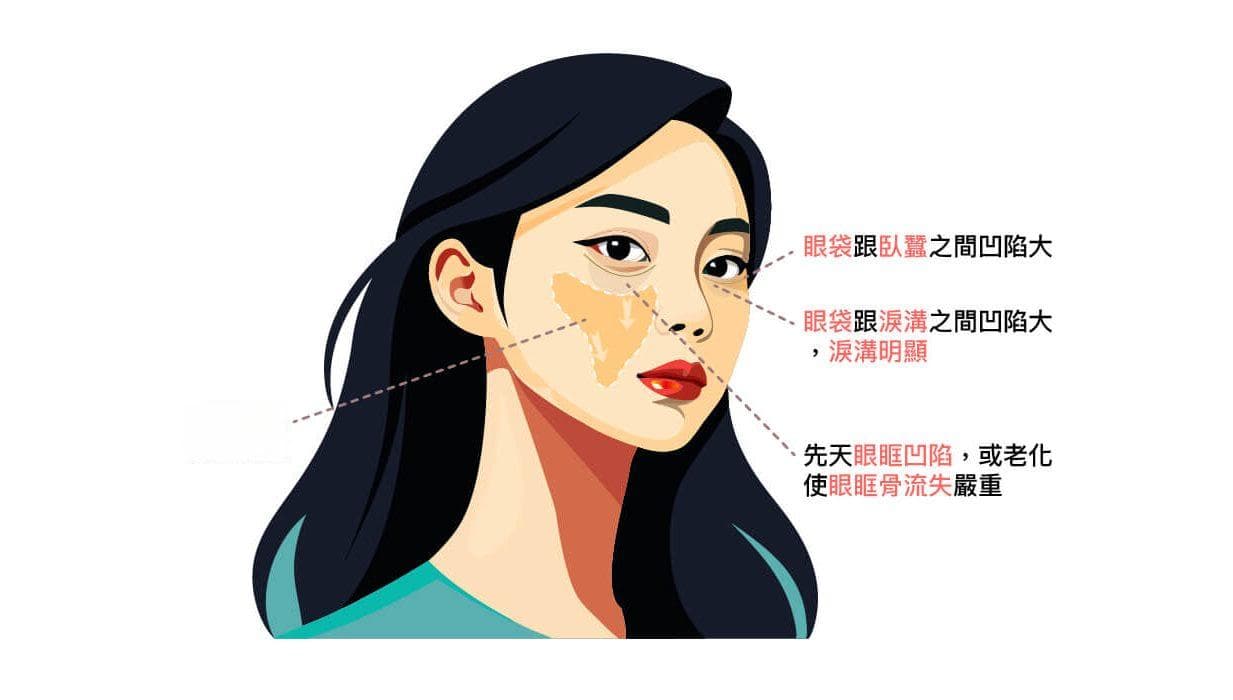 全攻略！黑眼圈成因、分类、预防与治疗