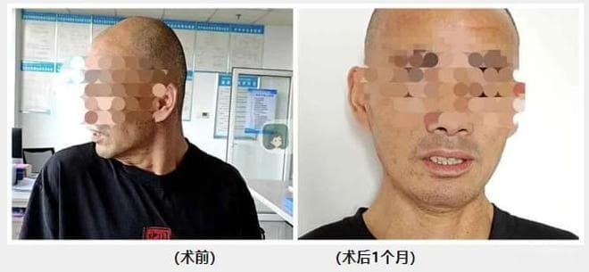 安庆市首例！改良Foerster-Dandy手术成功治愈痉挛性斜颈患者