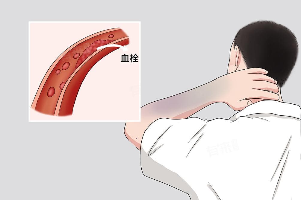 血栓溶栓的最佳时间