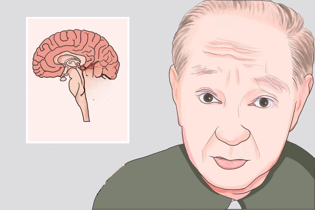 指鼻试验阳性代表什么