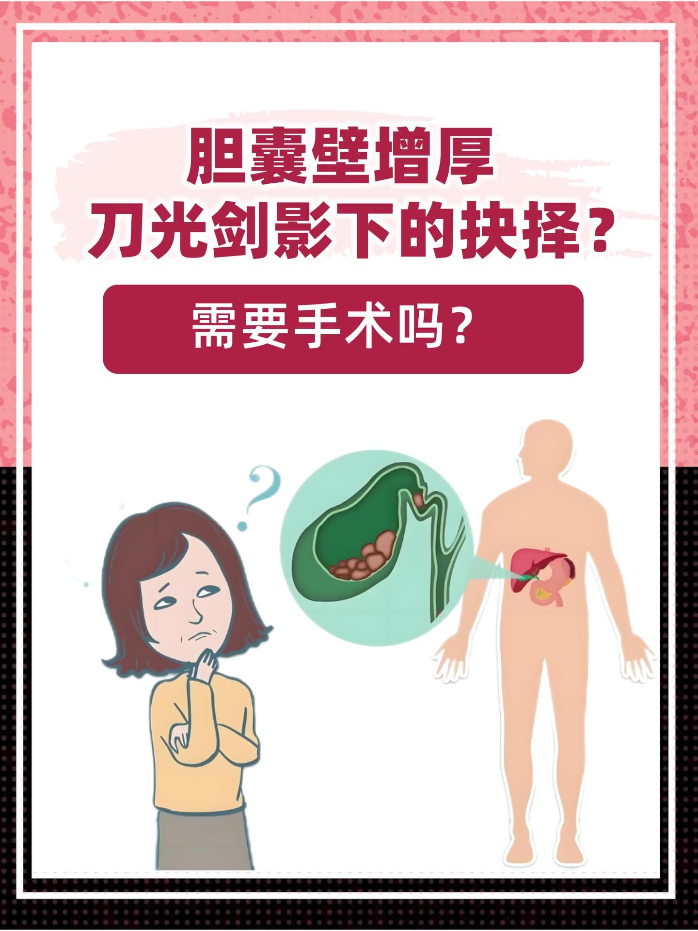 胆囊壁增厚，刀光剑影下的抉择？需要手术吗？