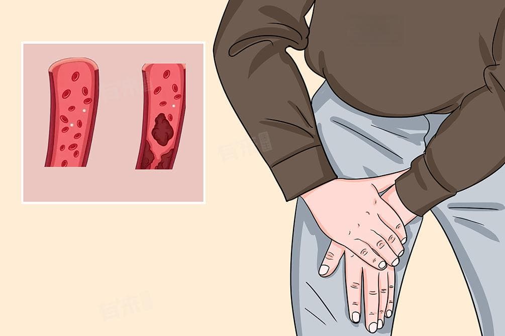 腿部血栓是否需要手术？一文详解治疗方案与日常护理