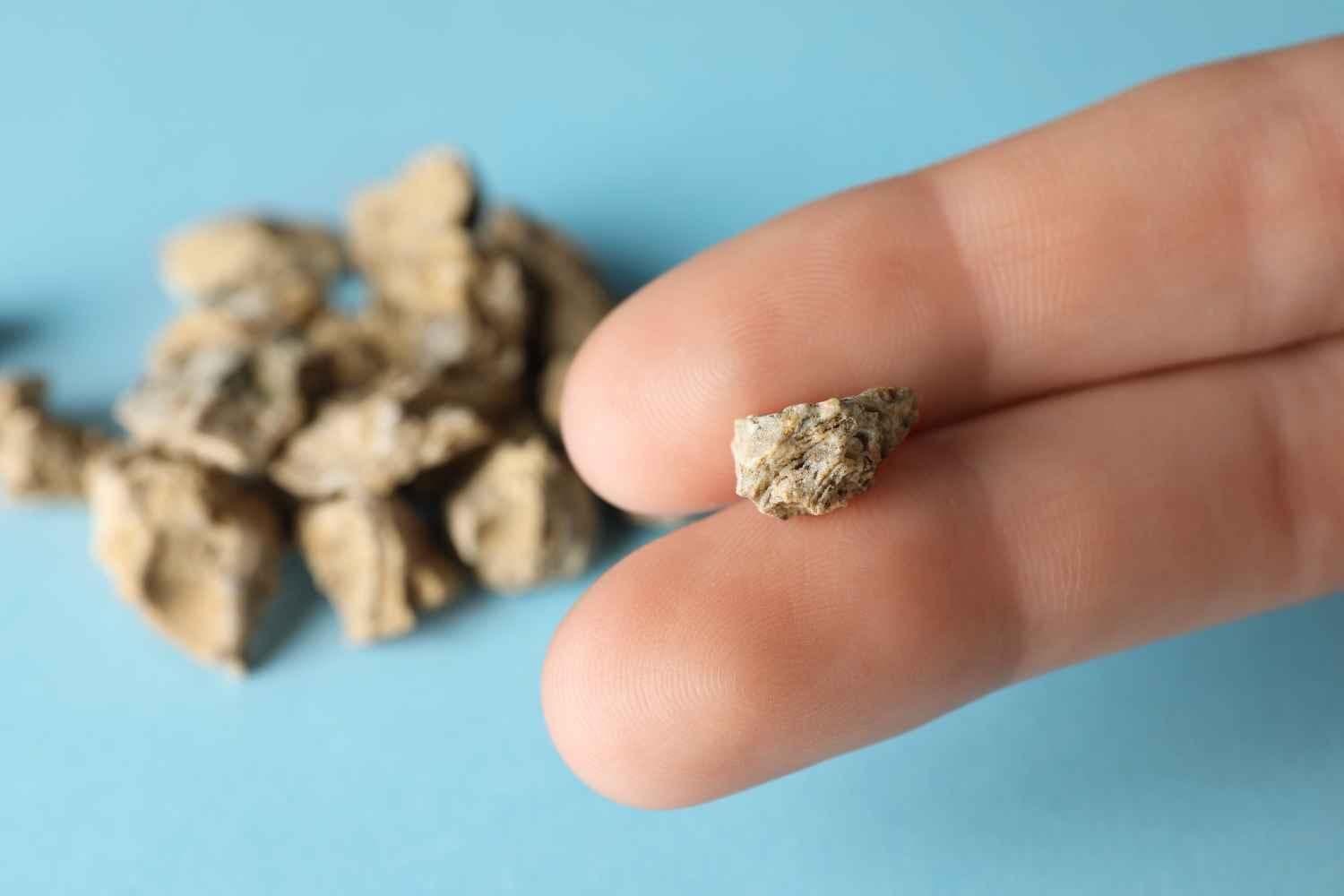 预防和治疗肾结石的饮食方法