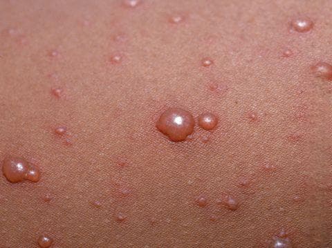 水痘：症状、传播与治疗全解析