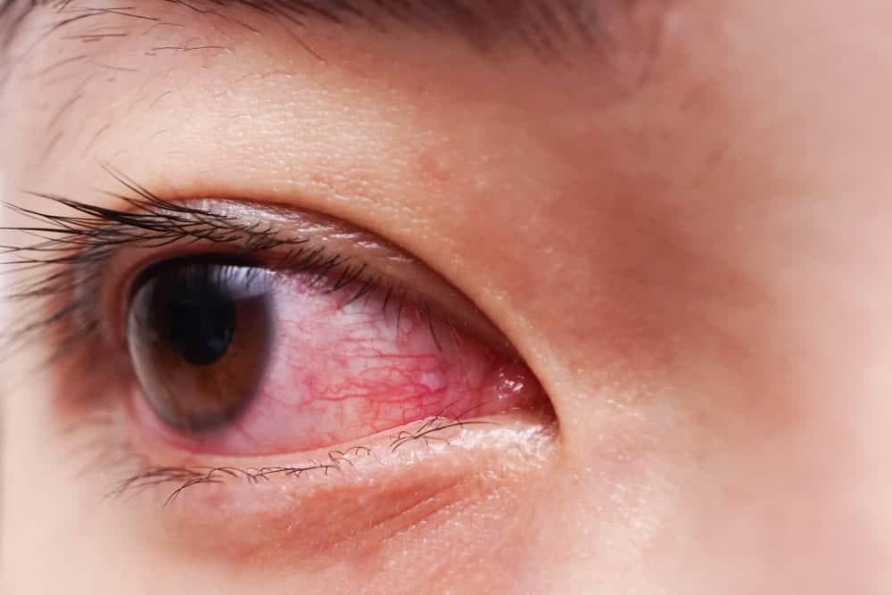 结膜炎症狀、原因解析！结膜炎多久會自己好？會傳染嗎？