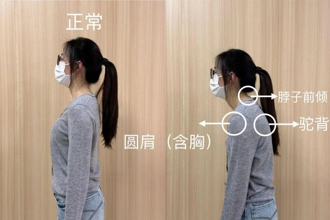 手机脖、电脑肩？“圆肩驼背人”的自救指南！