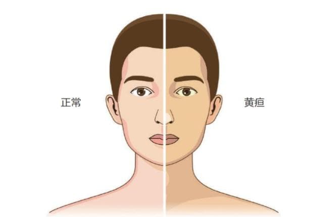 皮肤变黄怎么办？警惕病理性黄疸！