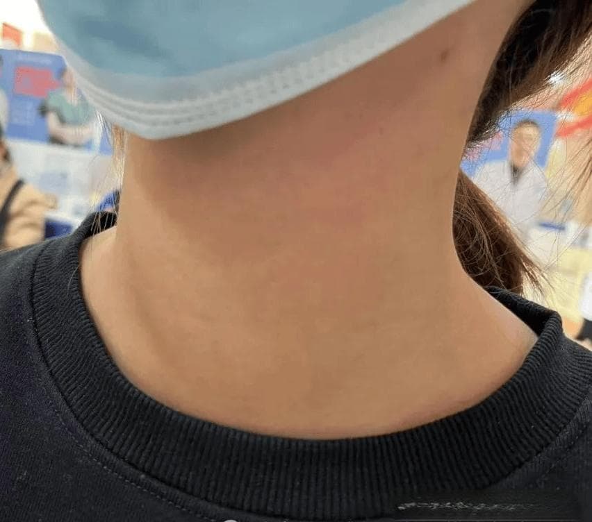 得了桥本甲状腺炎，该怎么办?