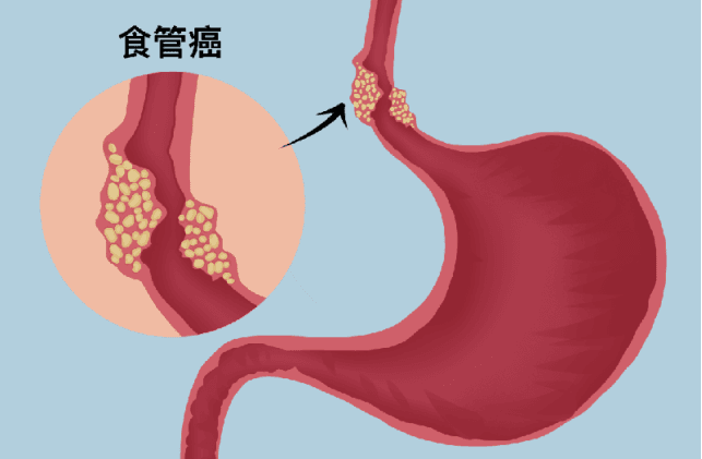 如何科学预防食管癌？