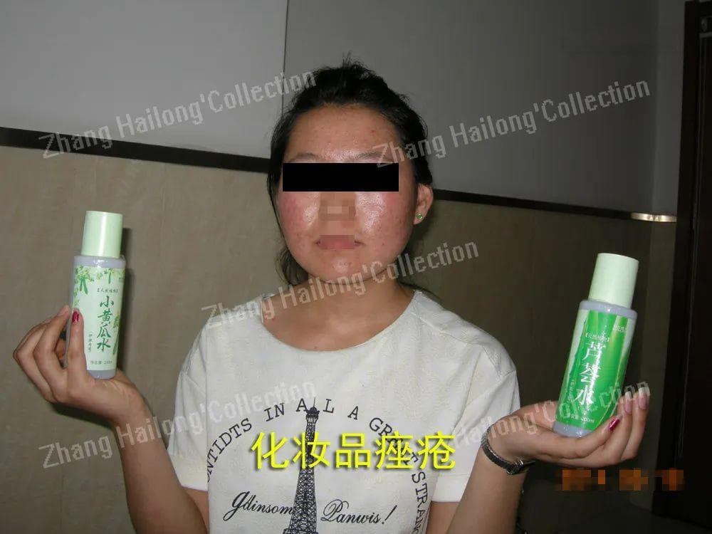 炎症性皮肤病与化妆品不良反应