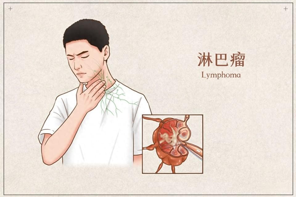 6类人群要注意，预防淋巴瘤！出现这些症状，及时去医院筛查！