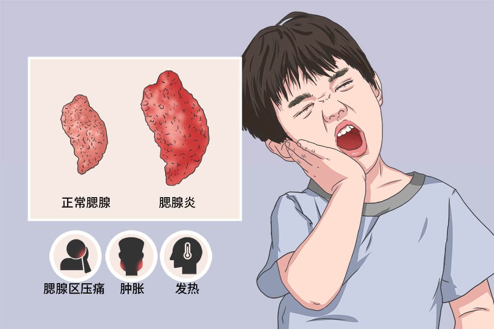 急性化脓性腮腺炎