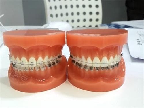 孩子矫正牙齿一般要花多少钱？25年不同矫正方式差异较大，起价在5000元起！