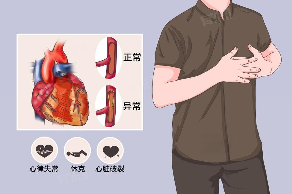 什么是冠状动脉硬化粥样硬化心脏病