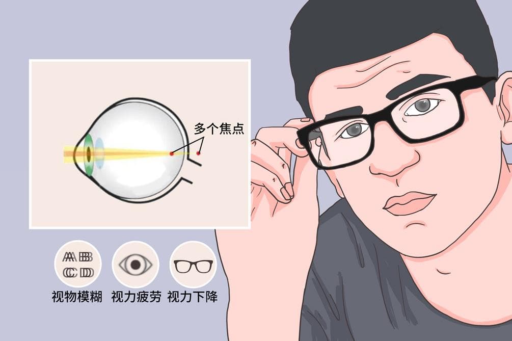 散光：症状、诊断与治疗全解析