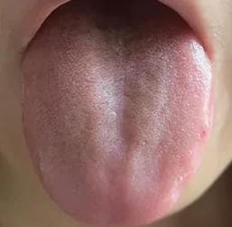 根据舌象来选择正确的补脾方式