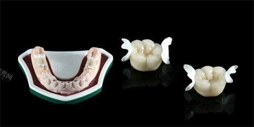 揭秘hpp支架义齿和粘接桥牙齿价格，一文读懂口腔修复费用