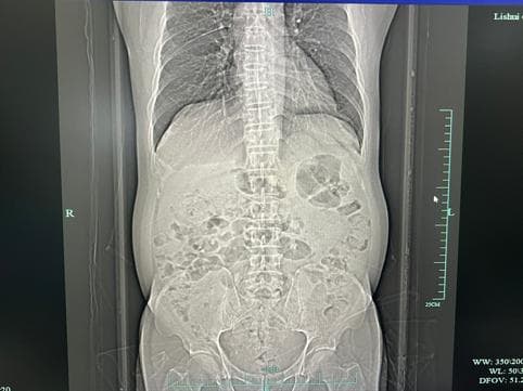 大意没重视，导致他切除一个肾！医生提醒：不痛的结石更危险