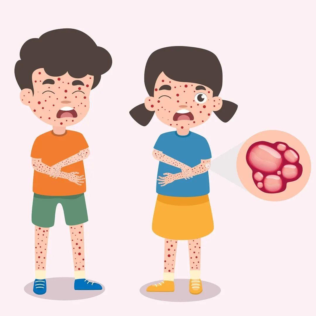 怕“热”的荨麻疹：发病机制与预防治疗全攻略