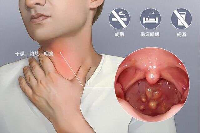 医生：拆解仲景半夏泻心汤，提供思路解决慢性胃咽喉炎和失眠