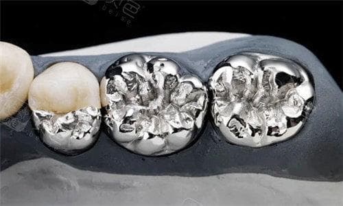 陶瓷牙齿VS金属牙齿,全方面剖析优缺点!全瓷牙与烤瓷牙又有何不同?
