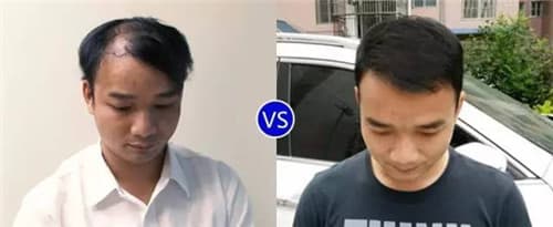 植发为什么只能从后枕部取发？