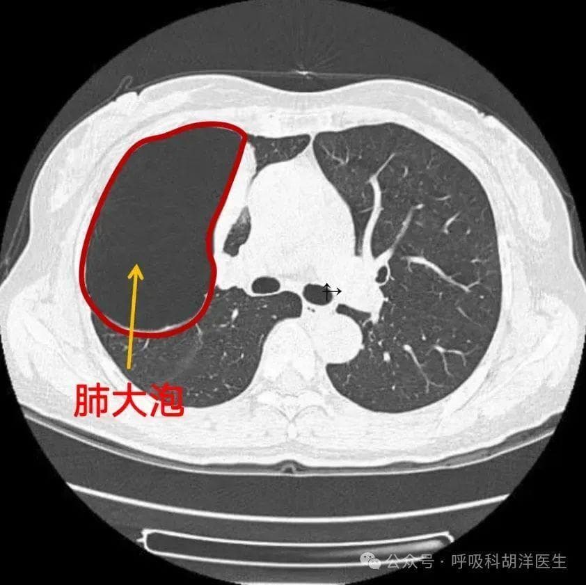 肺大泡影响肺功能，有些人需要终生用药，能做手术把它切除吗？