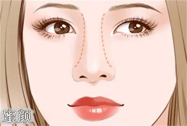 鼻子微整形：选择玻尿酸还是综合隆鼻？