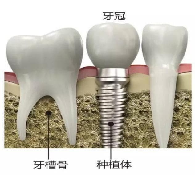 种牙时牙龈发炎了怎么办？种植牙后牙龈肿胀怎么消除？