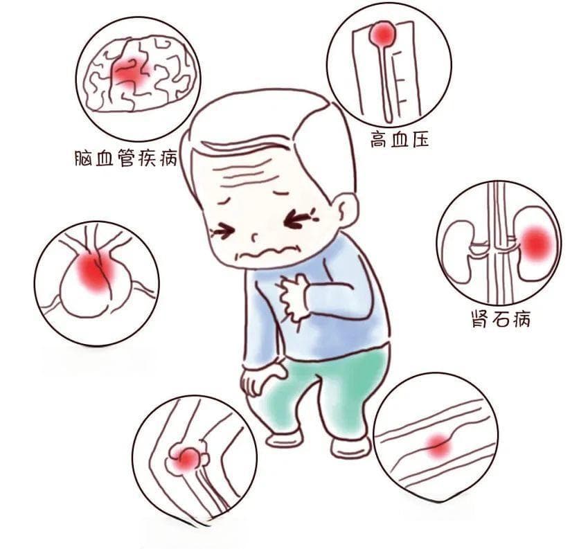 痛风急性发作怎么办？药物治疗和饮食注意事项全解析