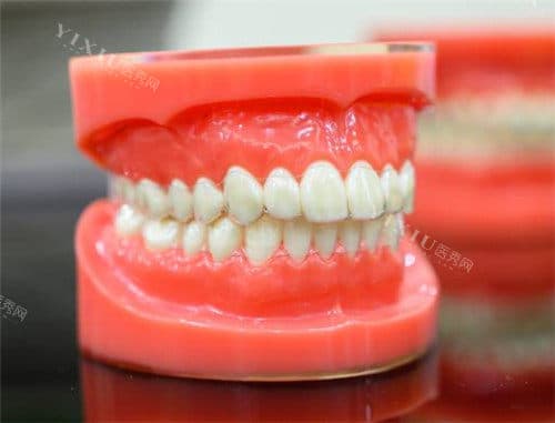 上下牙咬合错位怎么矫正？个性化矫正方案轻松get正确咬合，告别上下牙齿咬合难