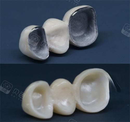 包牙冠后牙龈肿痛怎么办？六大原因及应对策略全解析