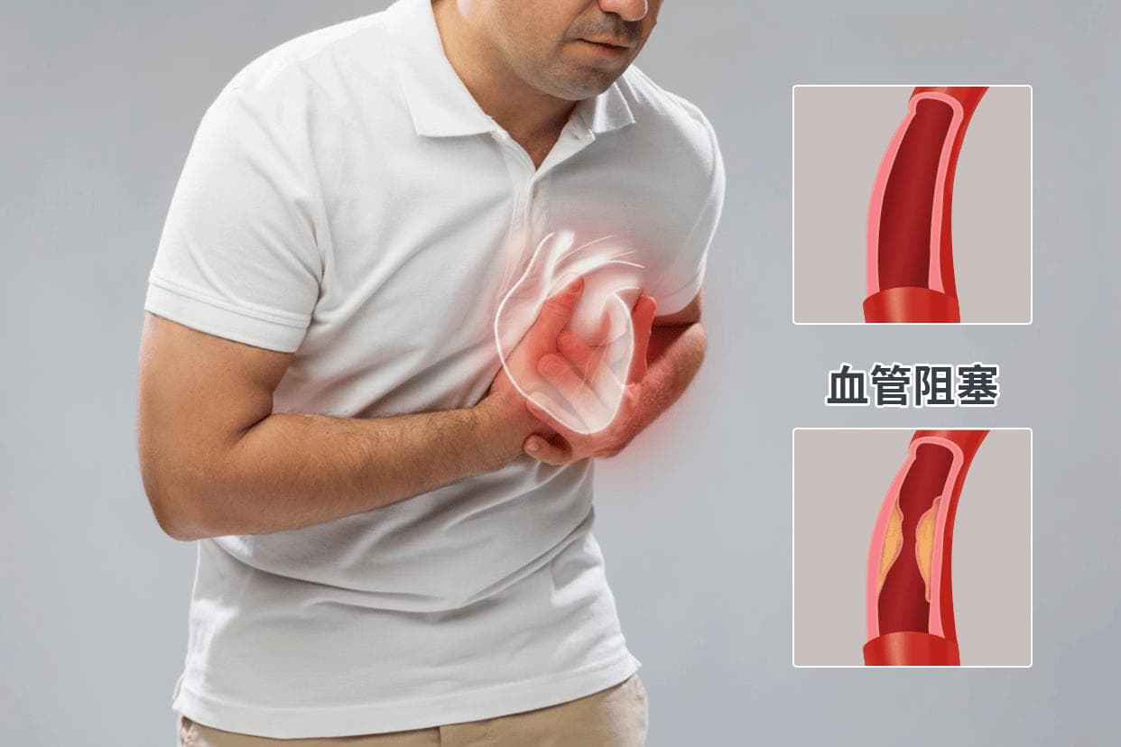 顺义心血管专家科普：心梗患者术后康复有哪些