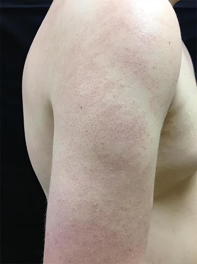 看又看不到，搓也够不着，后背上的痘，到底该怎么祛？
