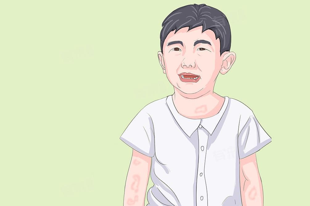 荨麻疹图片和症状治疗方法