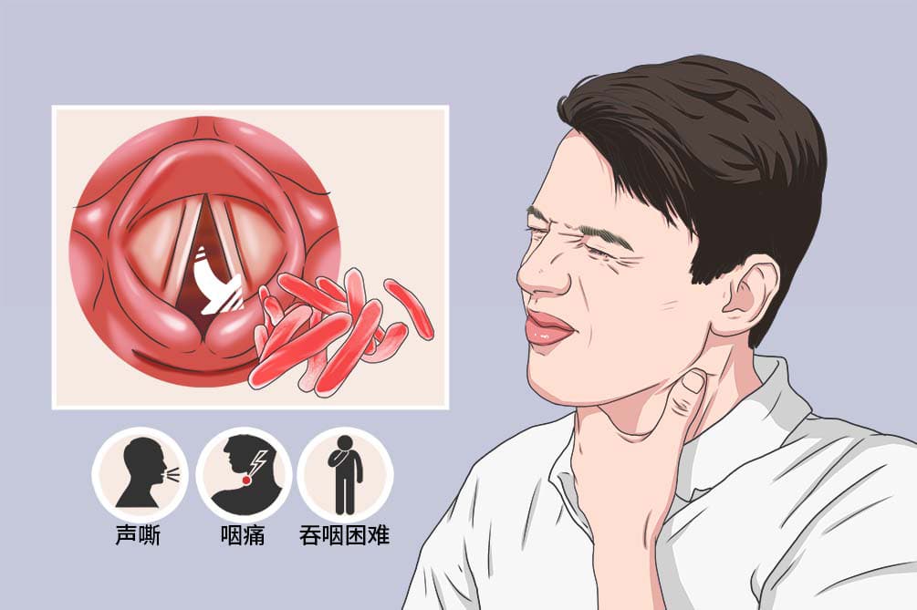 喉结核：症状、诊断与治疗全解析