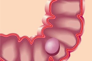 肠息肉手术需要多少钱？详解影响手术费用的关键因素