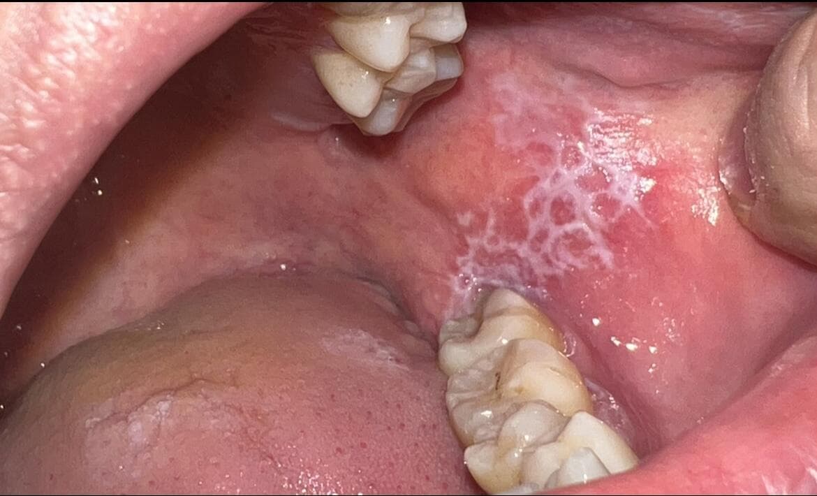 口腔扁平苔藓：为何忌口是关键？