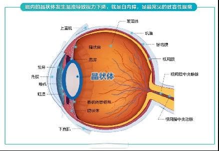 飞秒激光白内障手术的优势有哪些？北京爱尔英智眼科医院丁雪为您讲解