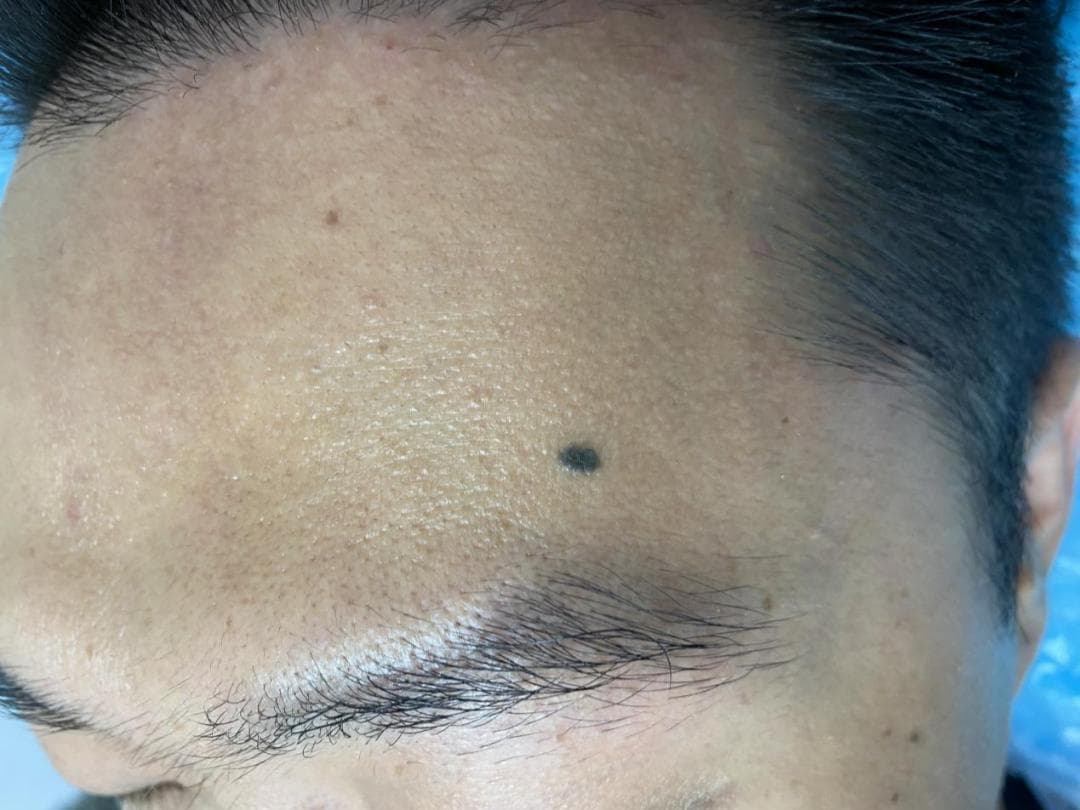 1个法则，教你识别会癌变的痣
