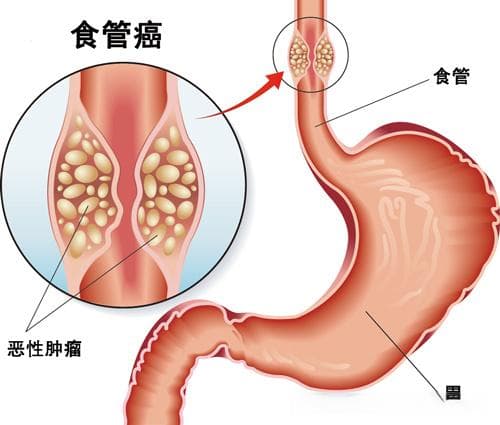 食道癌术后饮食起居全攻略：从禁食到正常饮食的五个阶段