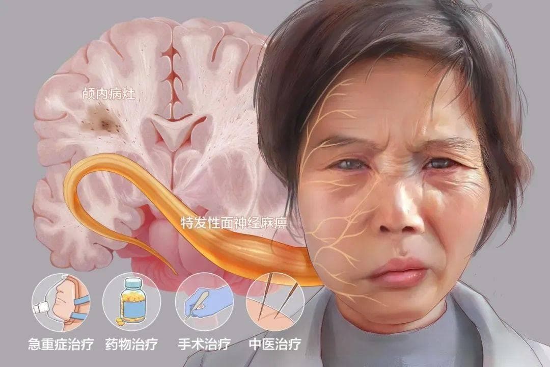 关于“面瘫”这种病，你需要知道这些