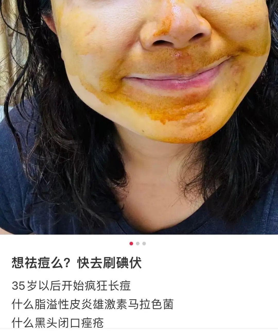 碘伏突变“美容神器”？专家：切勿乱用！
